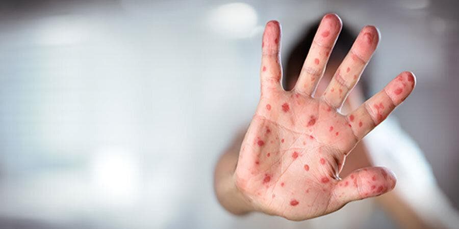 ابتلای ۲۹ نفر به بیماری سرخک در بابل