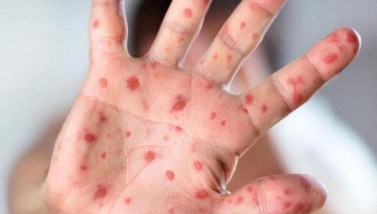سرخک ۲۹ نفر را در بابل روانه بیمارستان کرد
