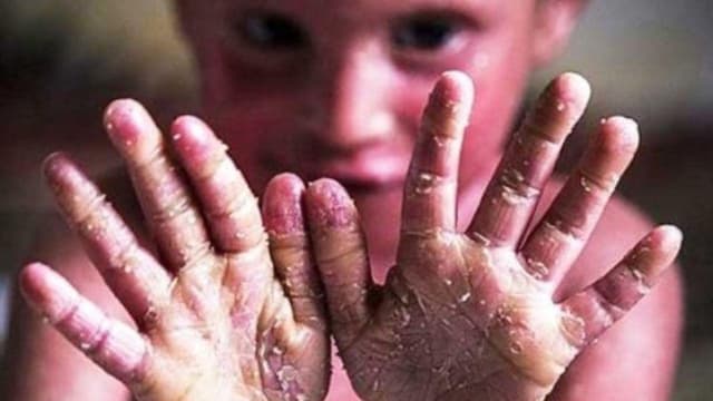 ۳۳ بیمار پروانه‌ای در همدان از بهزیستی خدمات دریافت می کنند