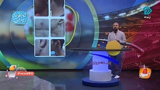 ابتلای کشتیگیران اندیمشک به بیماری پوستی + فیلم