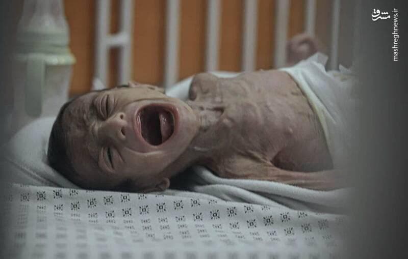 عکس/ کودک چهارماهه غزه‌ای در معرض سوءتغذیه شدید