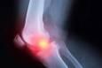 آرتروز دیگر فقط بیماری سالمندان نیست