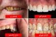 رنگ دندان از دیدگاه علم چه چیزهایی درباره سلامت شما می‌گوید؟(+عکس)