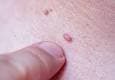 هر آنچه باید درباره بیماری HPV بدانید