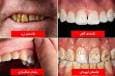 رنگ دندان از دیدگاه علم چه چیزهایی درباره سلامت شما می‌گوید؟