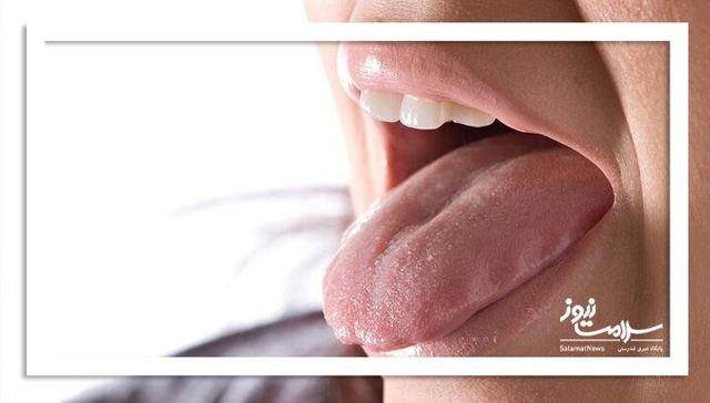 علائم کمخونی روی زبان