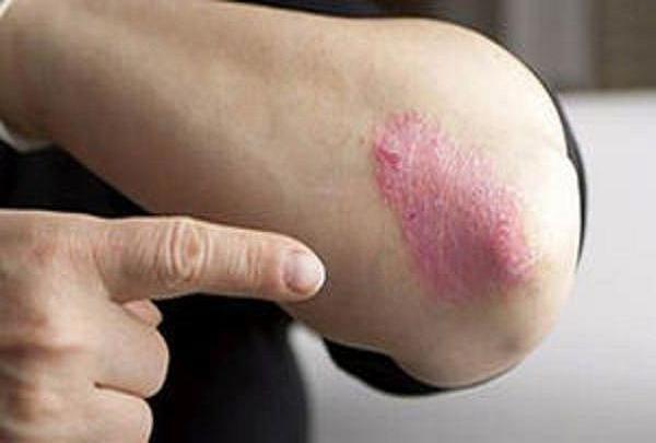از بیماری «پسوریازیس» چه می دانید