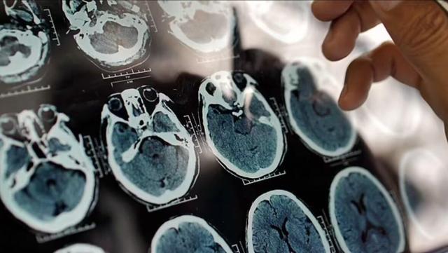 با مصرف این لبنیات از آلزایمر نجات پیدا کنید