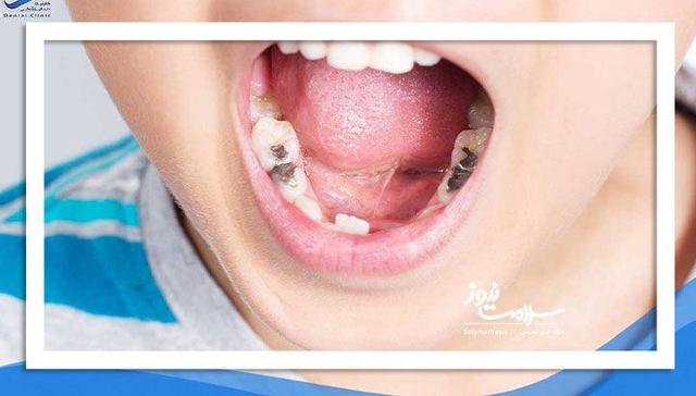 اولین ویزیت دندانپزشکی کودک باید تا یکسالگی انجام شود / هشدار درباره پوسیدگی زودرس و عادات نادرست دهانی