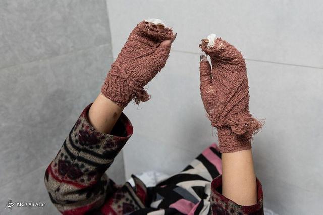 سوختگی؛ یکی از شدیدترین و پرهزینهترین آسیبهای جسمی/ چالش سوختگیهای ناشی از اسید