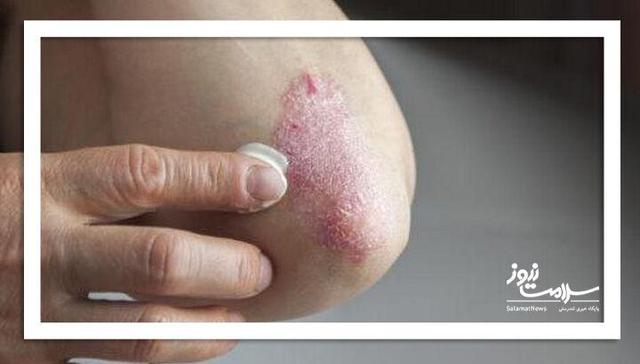 ۱۲ علت شایع پوستهپوسته شدن پوست