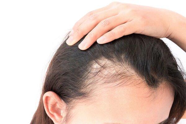 راهکاری برای رشد دوباره موهای ریخته شده