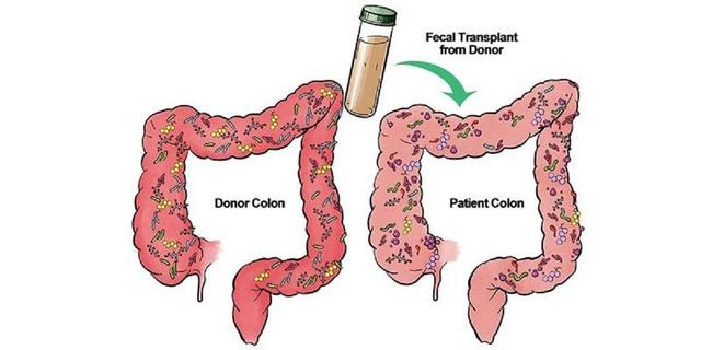 ایران در فهرست کشورهای پیشرفته درمان با پیوند مدفوع (اینفوگرافیک)